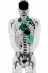 Algorithmes de segmentation par IA — traceurs FDG, PSMA et DOTATOC en imagerie médicale