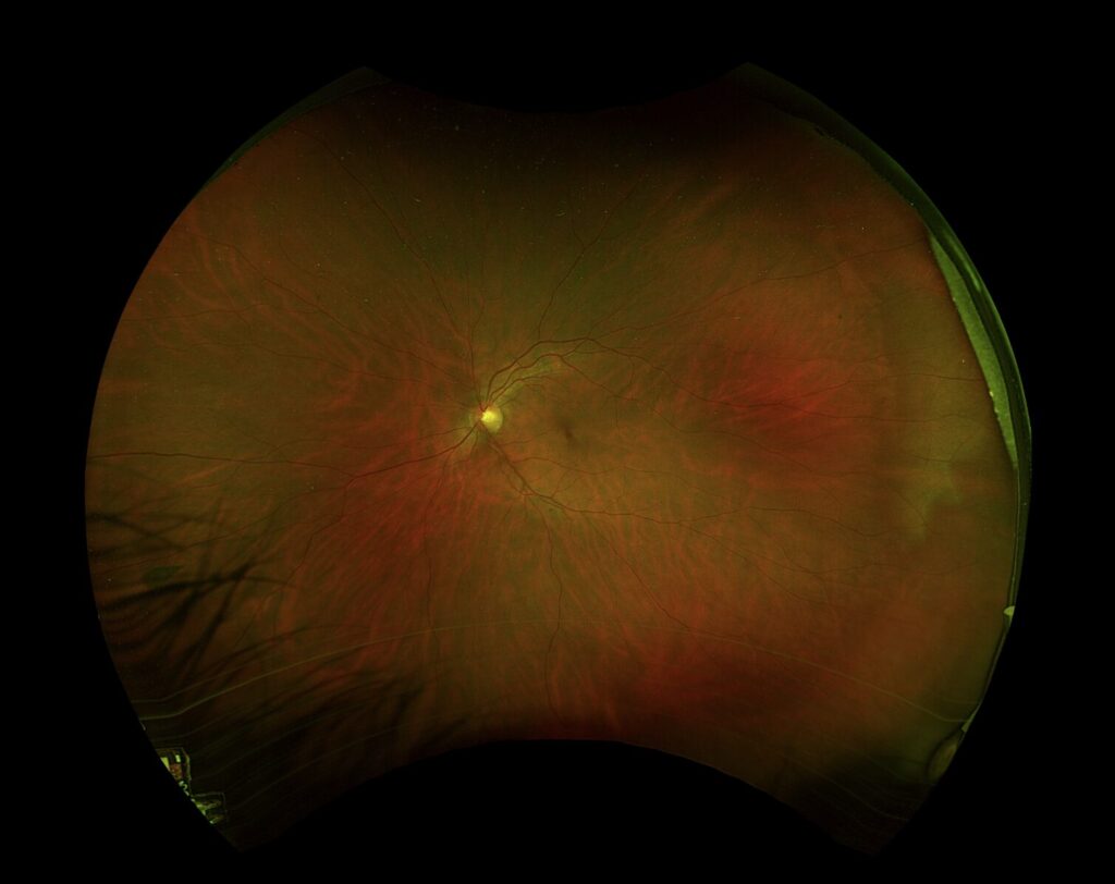 Imagerie optique ophtalmique affichant une photographie du fond d'œil pour l'évaluation en essai clinique.
