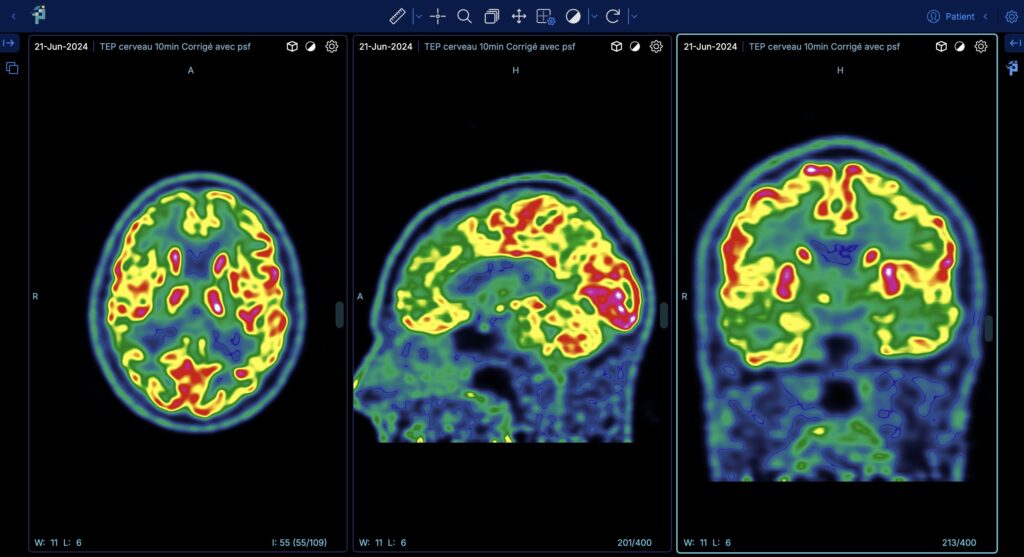 PET brain scan analysis displaying metabolic activity within the medical imaging interface.