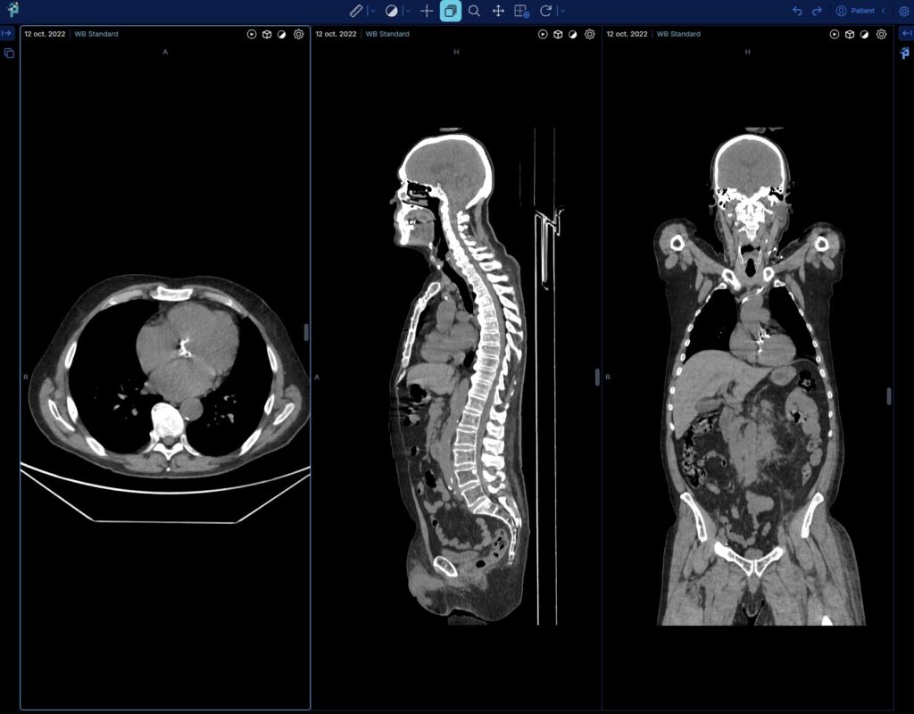 Multiplanar reconstruction of a chest and abdominal CT scan within the reading platform.