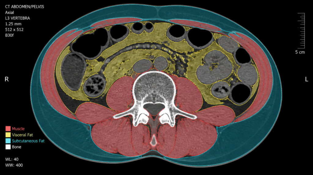 Axial CT slice at L3 vertebra level with colored AI segmentation of skeletal muscle, visceral and subcutaneous adipose tissues for body composition analysis.