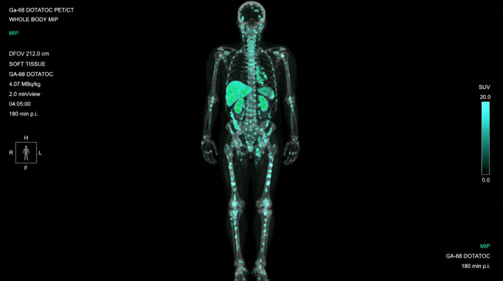 DOTATOC PET/CT scan with AI-generated tumor segmentation overlay highlighting neuroendocrine tumor lesions across multiple metastatic sites, processed by the Pixilib TMTV DOTA pipeline.