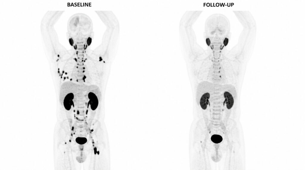 Side-by-side comparison of baseline and follow-up PSMA PET/CT MIP scans showing tumor burden reduction after treatment, quantified by TMTV PSMA in the Pixilib pipeline.